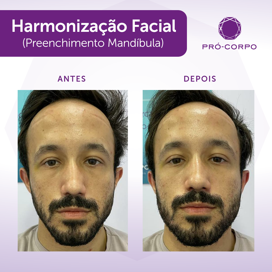 Harmonização Facial: Harmoniza e rejuvenesce o seu rosto