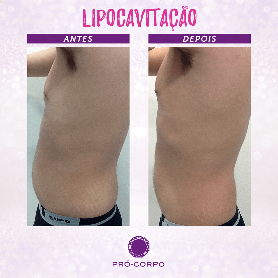 Lipocavitação: Tratamento para gordura localizada | Pró-Corpo