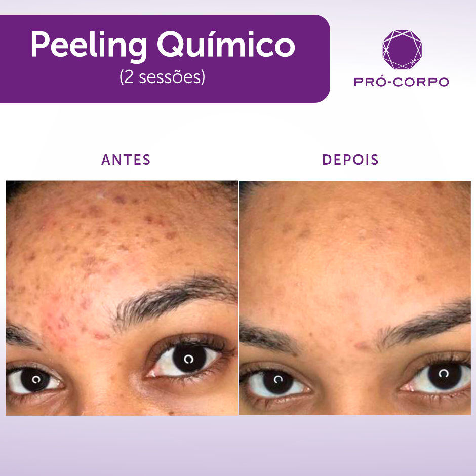 pueblo manejo Peticionario Peeling Químico: Eficaz Contra Rugas e Manchas | Pró-Corpo