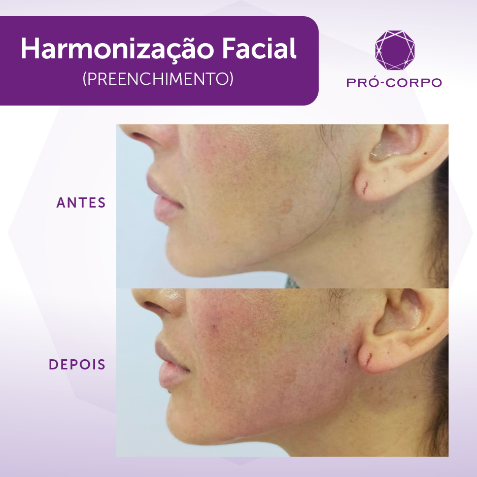 Harmonização Facial: Harmoniza e rejuvenesce o seu rosto