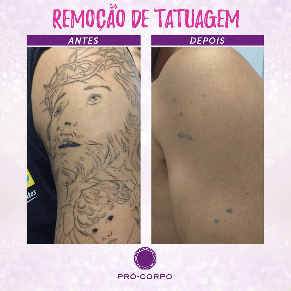 Remoção de Tatuagem: Dicas e informações | Pró-Corpo