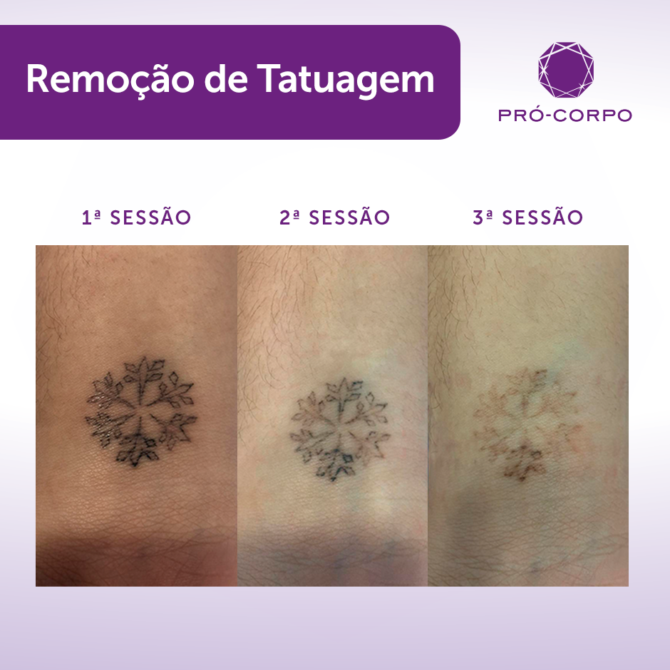 Remova Sua Tattoo Com Ate Off Pro Corpo