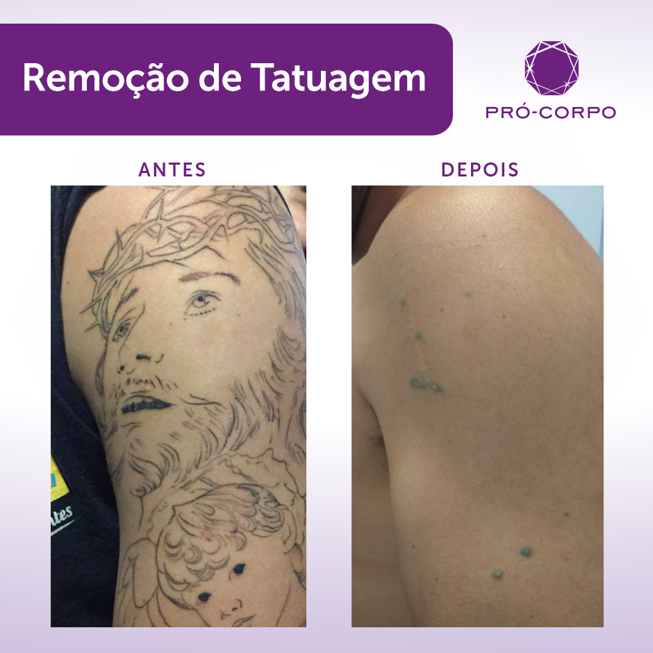 Remova Sua Tattoo Com Ate Off Pro Corpo