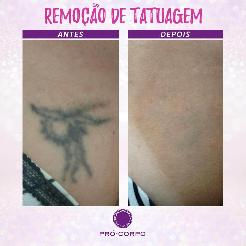 38++ Cclinica De Estetica Para Remover Tatuagem Info fotostatuagemlink