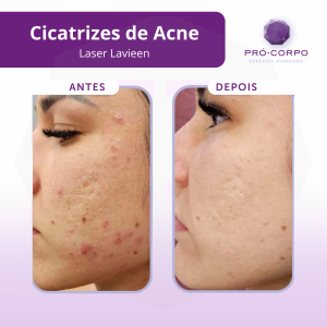 cicatrizes-de-acne