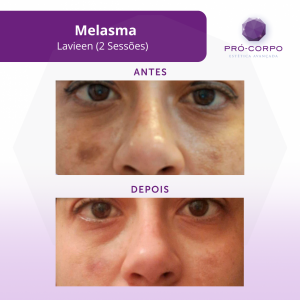 melasma