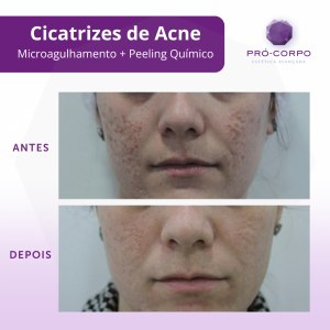 cicatrizes-de-acne