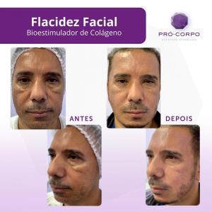 bioestimulador-de-colageno