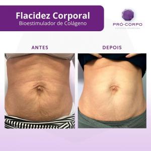bioestimulador-de-colageno