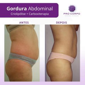 gordura-localizada