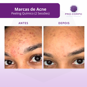 marcas-de-acne
