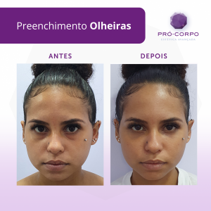 preenchimento-olheiras