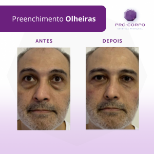 preenchimento-olheiras