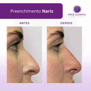 preenchimento-nariz