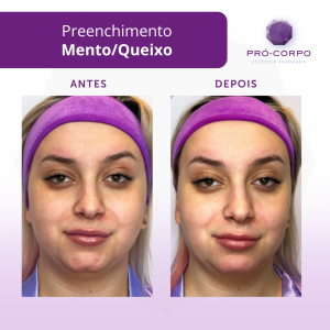 preenchimento-queixo