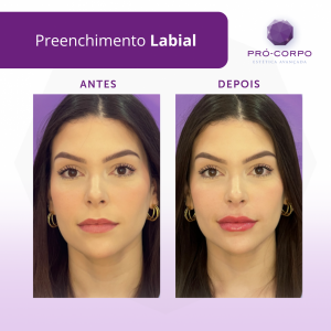 preenchimento-labial