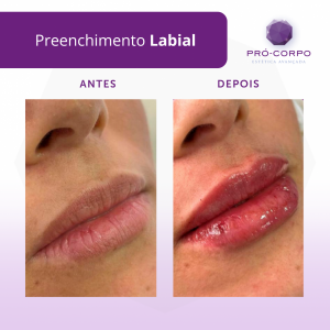 preenchimento-labial
