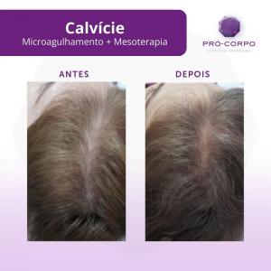 calvicie