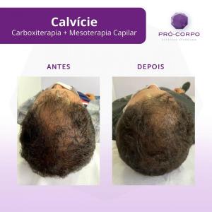 calvicie
