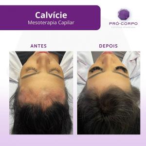 calvicie