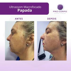 papada