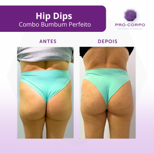 hipdips