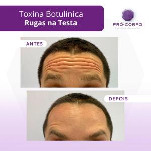 rugas