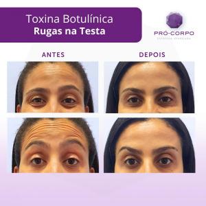rugas