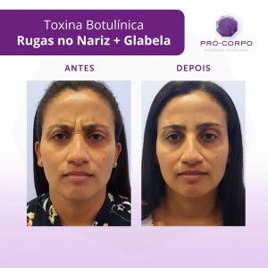 rugas