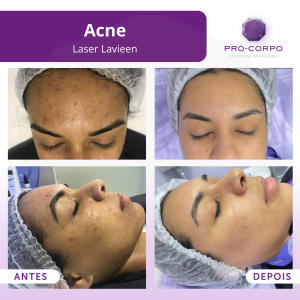 tratamento_de_acne
