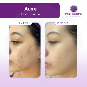 tratamento_de_acne