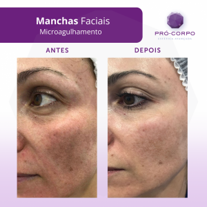 manchas-faciais
