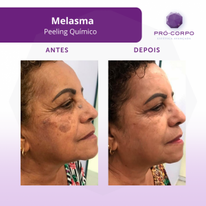 melasma