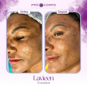 Antes e depois Lavieen--melasma