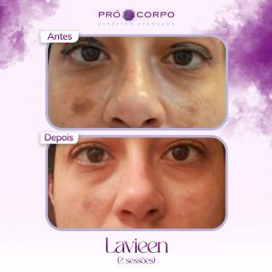 Antes e depois Lavieen 