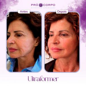 antes e depois ultraformer- ultraformer 3 - antes e depois