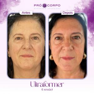 antes e depois ultraformer- ultraformer 3 - antes e depois