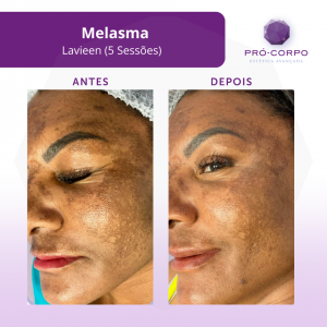melasma