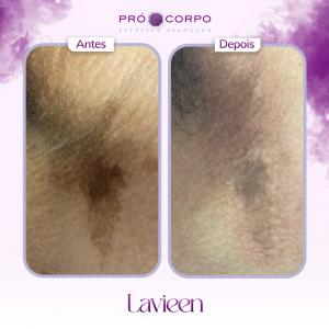 fotos-antes-e-depois-lavieen