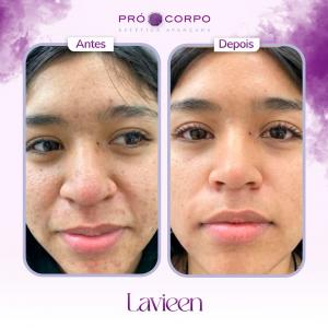 fotos-antes-e-depois-lavieen