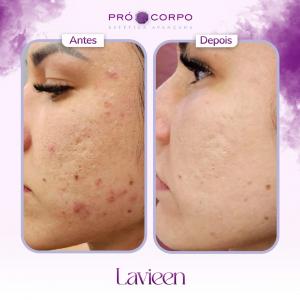 Lavien Manchas de acne-antes-e-depois