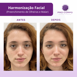 Harmonização Facial