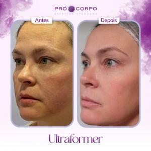 antes e depois ultraformer- ultraformer 3 - antes e depois