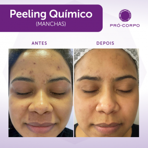 Peeling Químico Fotos Antes e Depois