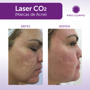 Laser CO2 Fracionado Fotos Antes e Depois