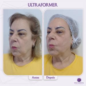 antes e depois ultraformer