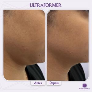 antes e depois ultraformer- ultraformer 3 - antes e depois