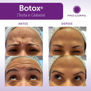 Botox ®: Fotos Antes e Depois