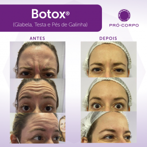 Botox ®: Fotos Antes e Depois