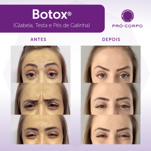 botox-3-areas--Jessica